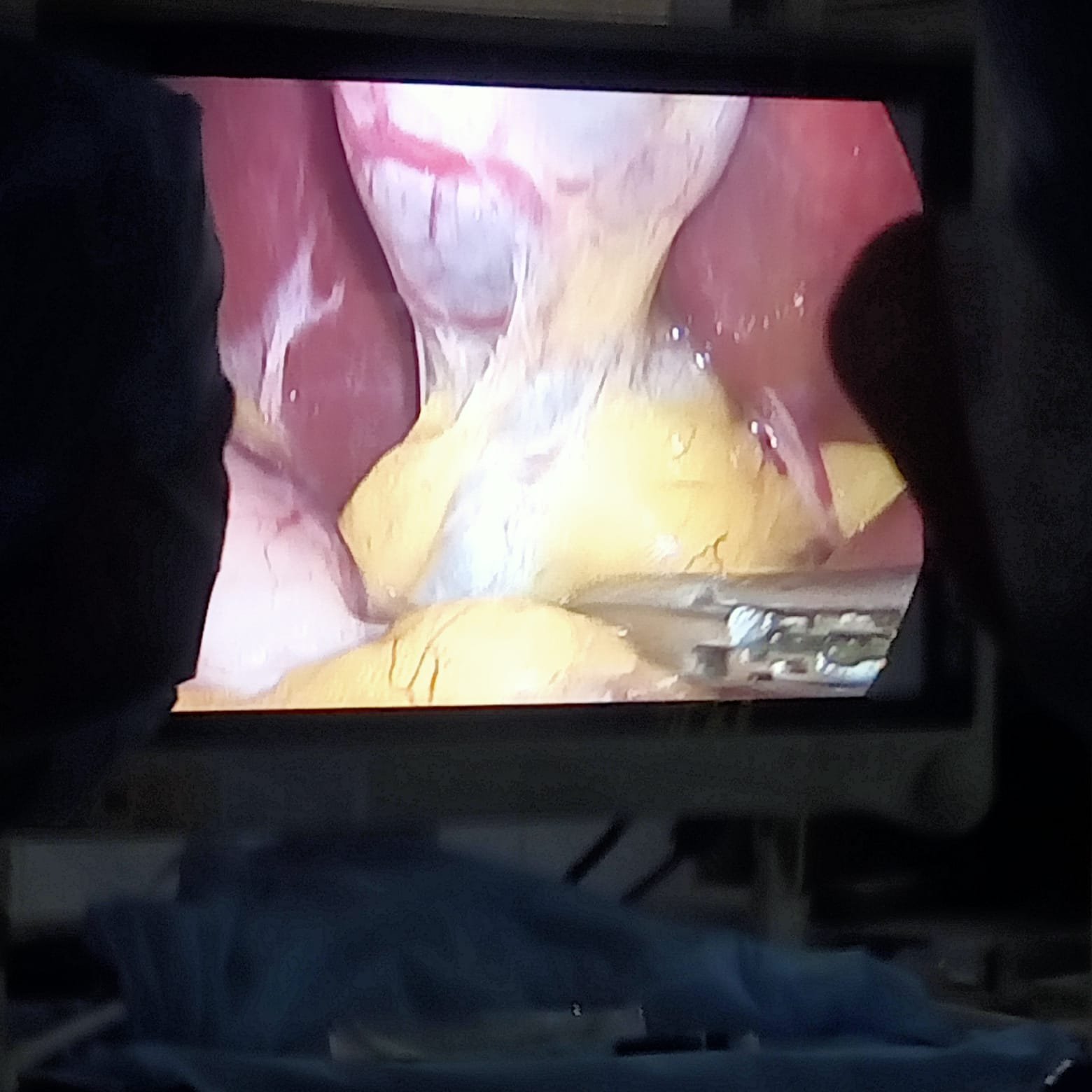 Laparoscopic Surgery